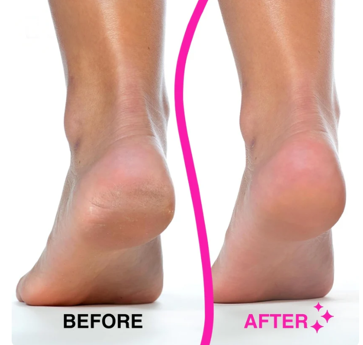 Stepoa Pro Callus Remover™