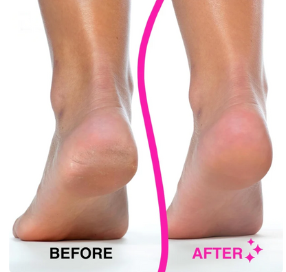 Stepoa Pro Callus Remover™